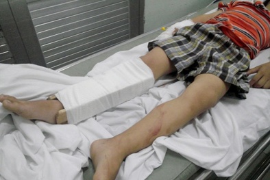 Bố dượng độc ác đánh cháu bé 6 tuổi gãy chân