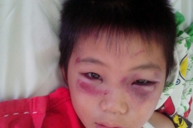 Tin mới nhất vụ bố dượng đánh con riêng của vợ chấn thương sọ não, gãy 2 tay 1 chân