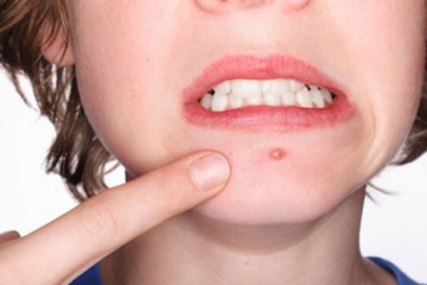 Tác hại nguy hiểm của việc nặn mụn