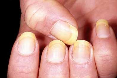 Cách điều trị bệnh vẩy nến hiệu quả và nhanh chóng