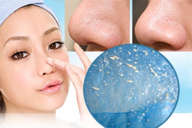 4 cách loại bỏ mụn đầu đen nhanh và hiệu quả nhất