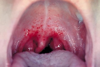 Triệu chứng báo hiệu ung thư vòm họng không thể coi thường