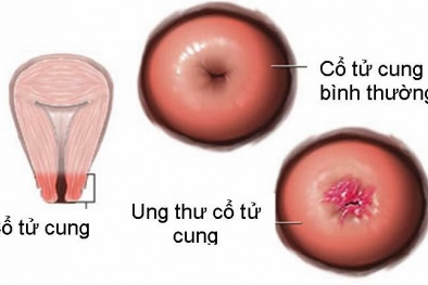 Ung thư cổ tử cung, căn bệnh tử vong hàng đầu ở phụ nữ