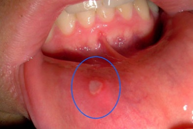 Những loại thuốc trị nhiệt miệng hiệu quả hiện nay