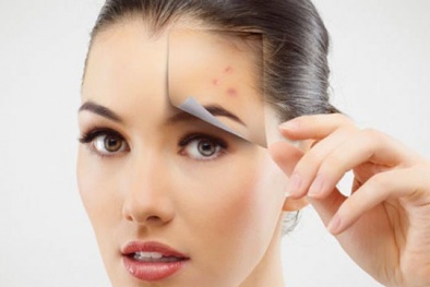 Cách trị mụn thâm hiệu quả và nhanh nhất