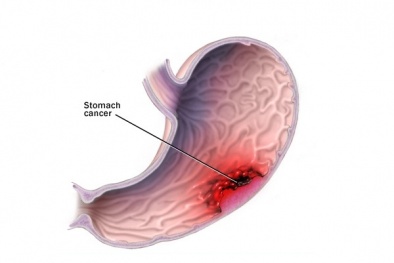 Nhận biết dấu hiệu ung thư dạ dày và phương pháp chữa trị