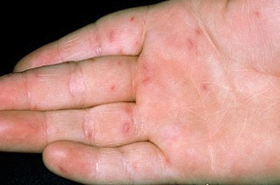 Hà Nội: Xuất hiện 5 ổ dịch tay chân miệng