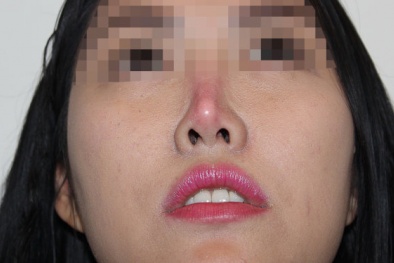 Nhu cầu thẩm mỹ tăng, tai biến tăng theo