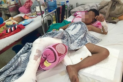 Cho khỉ ăn, chú tiểu 8 tuổi bị cắn đứt dây thần kinh chân