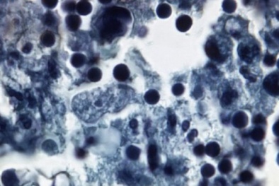 4 loại ký sinh trùng 'ăn thịt' cực nguy hiểm 