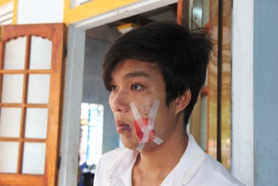 Công an xã 'lỡ tay' bắn đạn cao su vào mặt người vi phạm giao thông