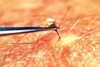 Bị cả bầy ong vò vẽ tấn công vì đi vệ sinh ồn ào