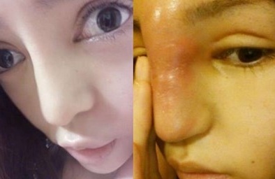 Sở hữu chiếc mũi vòi voi vì quá ham mê phẫu thuật thẩm mỹ