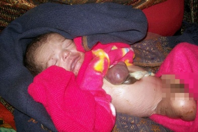 Xôn xao vụ em bé Ấn Độ sinh ra với trái tim bên ngoài