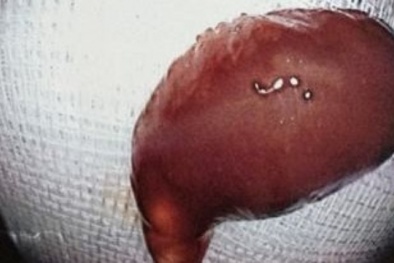 Nôn ra sán lá ruột màu hồng vì thói quen ăn sống