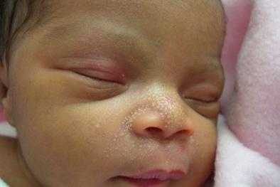 Các dấu hiệu dị ứng, bệnh ngoài da của trẻ sơ sinh