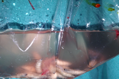 Hốt hoảng với ca bệnh hiếm gặp: Ổ giòi to bằng đầu đũa ký sinh trong đầu