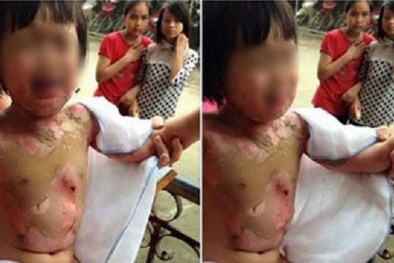 Bé gái 3 tuổi bị đốt ở trường: Sẽ xem xét trách nhiệm cô giáo