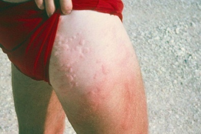 Những căn bệnh hãi hùng trong bể tắm nghìn người công viên nước