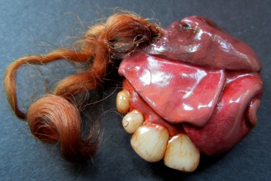  Hoảng hồn người phụ nữ có bào thai đôi trong...não