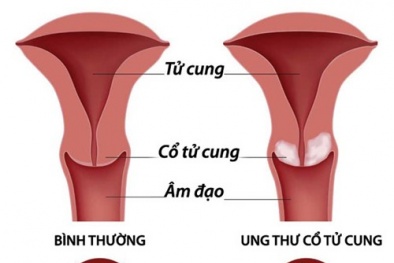 Cảnh giác 7 dấu hiệu ung thư cổ tử cung
