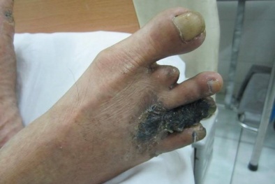 Phòng tránh biến chứng nghiêm trọng khi bị sứa cắn