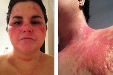 Tránh phù nề khắp người và trụy tim mạch khi bị dị ứng hải sản