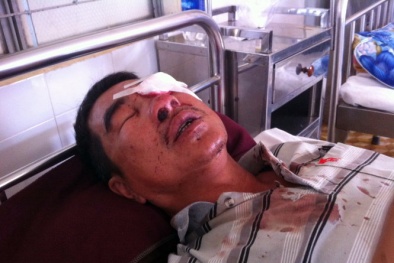 Thanh niên ném đá cho vui  gây mù mắt hành khách đi tù