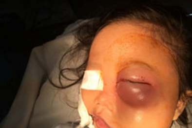 Bất ngờ bị khỉ cắn, bé gái 4 tuổi suýt bị mù mất 1 mắt