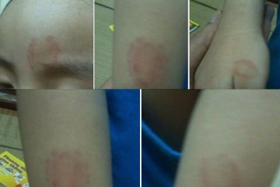 Vết thương do người cắn có nguy hiểm?