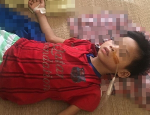 Uống nhầm axit, bé trai 7 tuổi phải cắt bỏ gần hết dạ dày 