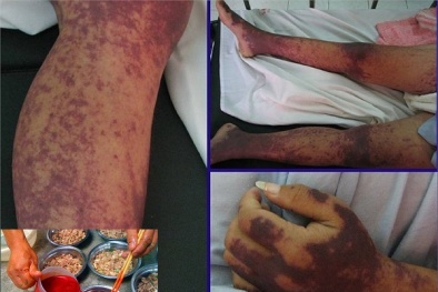 Lại thêm người tử vong, viêm màng não mủ vì tiết canh lợn