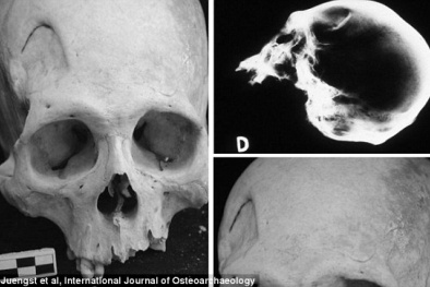 Phát hiện xương cổ đại minh chứng quá trình phẫu thuật não nguyên thủy