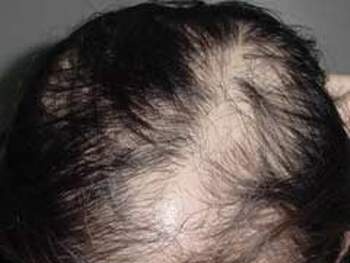 Trọc lốc đầu vì chăm sóc tóc không đúng cách