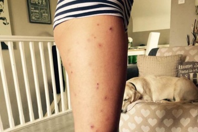 Người phụ nữ mắc chứng bệnh không thể ngừng gãi ngứa 