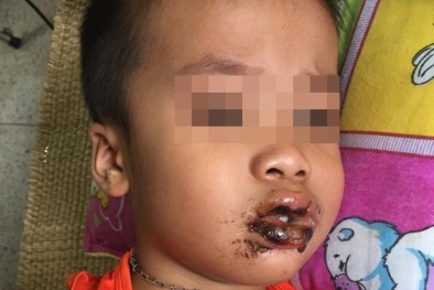 Ăn nhầm bột thông cống, 4 cháu bé nhập viện tập thể