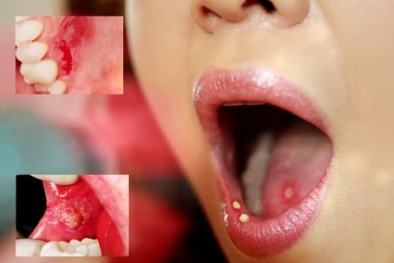 Ung thư tuyến nước bọt dễ nhầm với nhiệt miệng