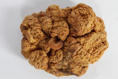 Mầm bệnh từ ‘thần dược’ nhau thai 