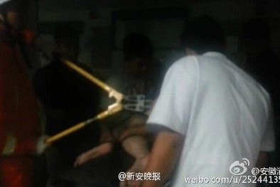 Trung Quốc: Người đàn ông nhét cả một chiếc ô vào hậu môn