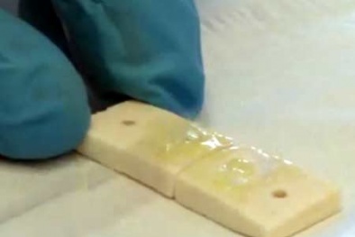 Keo dán xương: Công cụ hỗ trợ đắc lực giúp bác sĩ tăng chất lượng điều trị