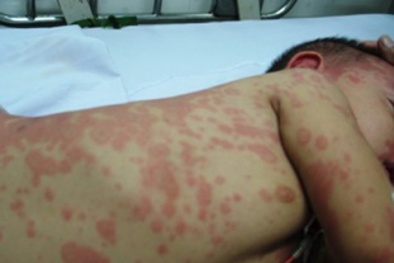 Nguy cơ bùng phát dịch sốt xuất huyết ở cả 2 miền