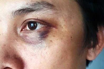 Tác nghiệp tai nạn giao thông, phóng viên báo Hà Nội Mới bị đánh bầm dập