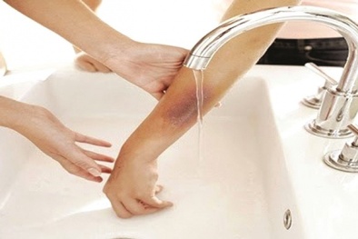 Cách sơ cứu vết bỏng cho trẻ khi bị bỏng nước sôi