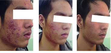 Nhận biết mỹ phẩm chứa corticoid 'làm đẹp thần tốc'