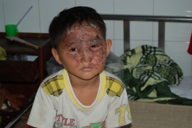 Bé trai bỏng nặng vì chơi lồng đèn trung thu