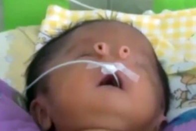 Chuyện lạ có thật: Em bé sinh ra có hai ‘mũi’