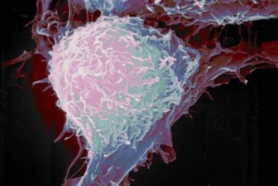 5 dấu hiệu cảnh báo bệnh ung thư ở người trẻ