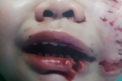 Bé trai bị chó nhà cắn phải khâu gần 200 mũi trên mặt