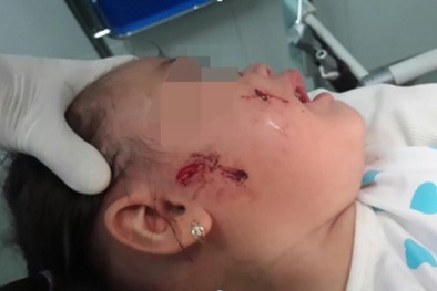 Những vụ trẻ bị chó cắn thương tâm thời gian qua