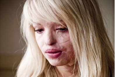 Sơ cứu khẩn cấp cho người bị bỏng axit